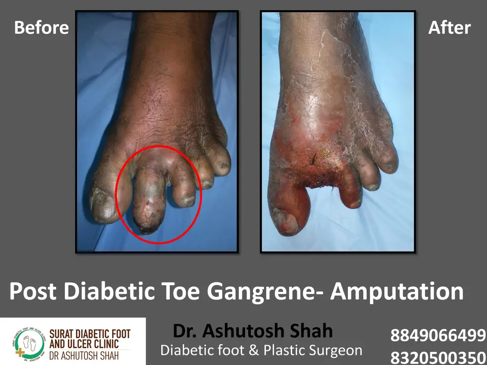 Diabetic Foot  PPT 3 checked by sir.pptx-35.webp